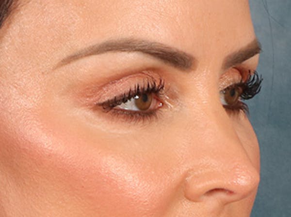 Eyelid Lift Before & After Gallery - Patient 137947 - Image 4