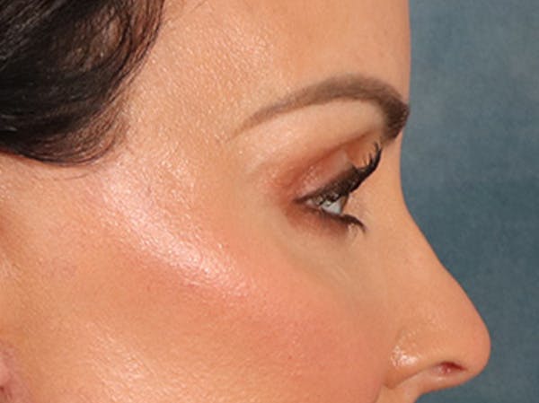 Eyelid Lift Before & After Gallery - Patient 137947 - Image 6