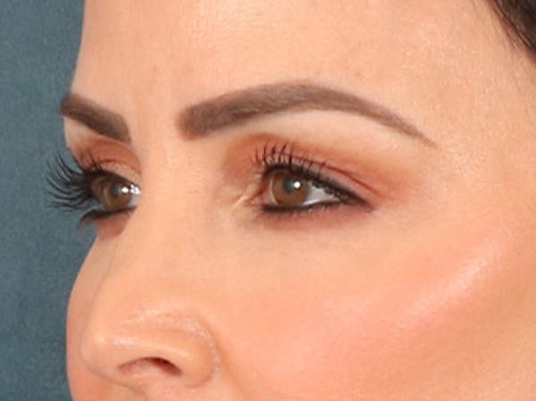 Eyelid Lift Before & After Gallery - Patient 137947 - Image 7