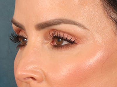 Eyelid Lift Before & After Gallery - Patient 137947 - Image 8