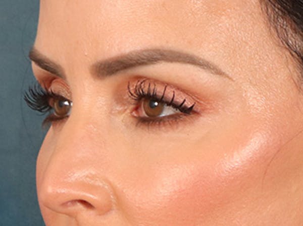 Eyelid Lift Before & After Gallery - Patient 137947 - Image 8