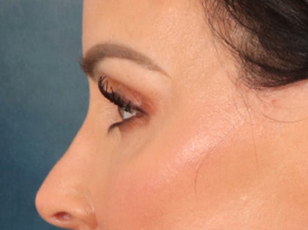 Eyelid Lift Before & After Gallery - Patient 137947 - Image 10