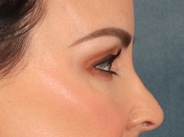 Eyelid Lift Before & After Gallery - Patient 137947 - Image 5