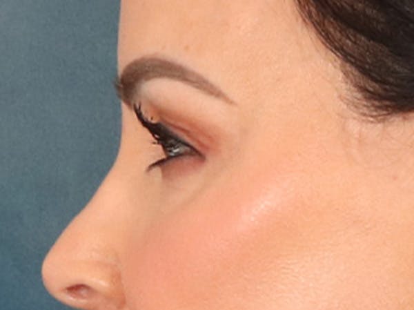 Eyelid Lift Before & After Gallery - Patient 137947 - Image 9