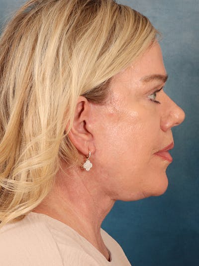 Brow Lift Before & After Gallery - Patient 356831 - Image 6