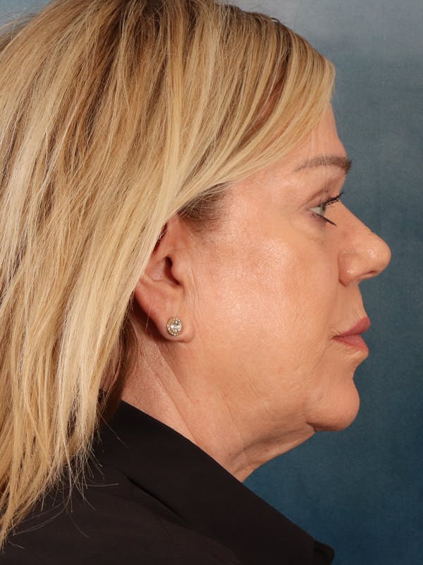Brow Lift Before & After Gallery - Patient 356831 - Image 5