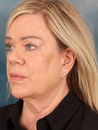 Deep Plane Facelift Before & After Gallery - Patient 292354 - Image 1