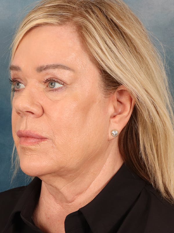 Brow Lift Before & After Gallery - Patient 356831 - Image 7