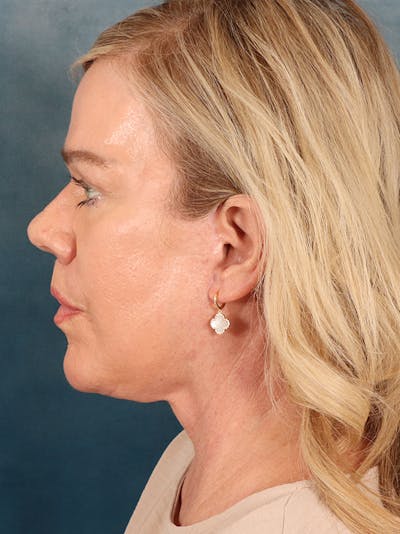 Brow Lift Before & After Gallery - Patient 356831 - Image 10