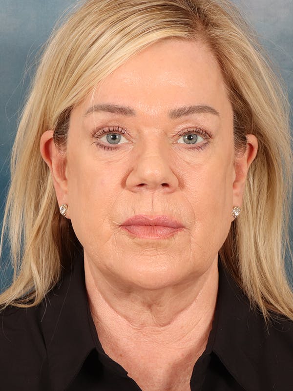 Brow Lift Before & After Gallery - Patient 356831 - Image 1