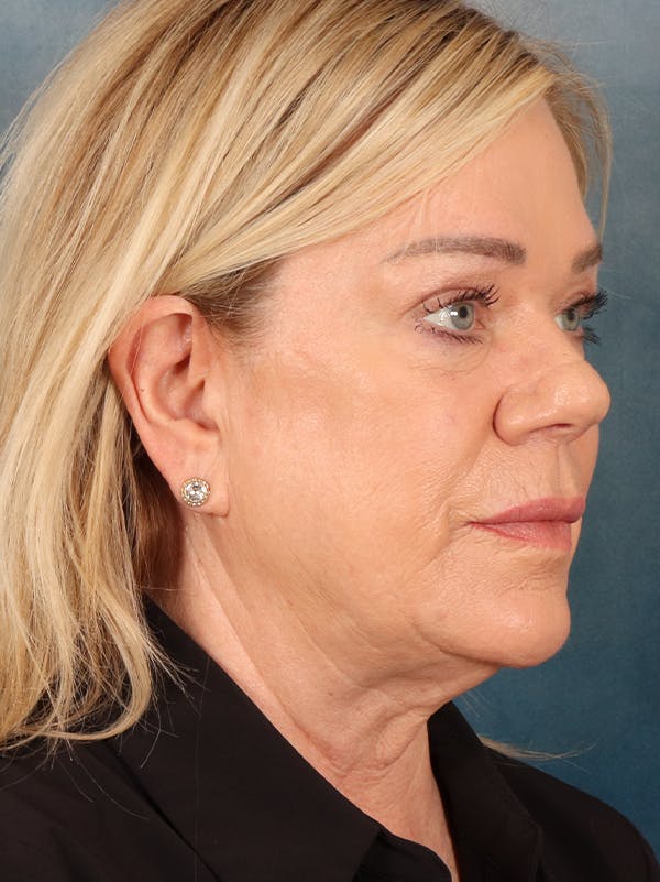 Brow Lift Before & After Gallery - Patient 356831 - Image 3