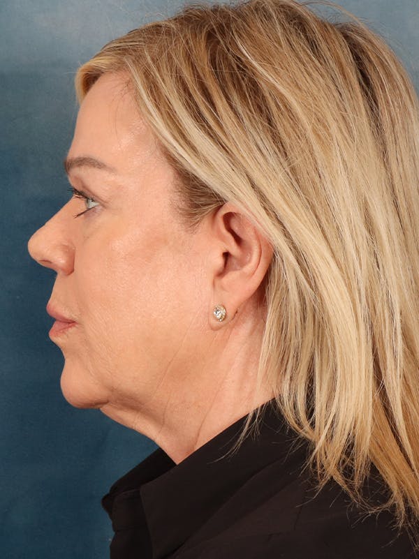 Brow Lift Before & After Gallery - Patient 356831 - Image 9