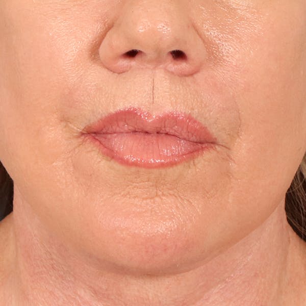 Lip Lift Before & After Gallery - Patient 367395 - Image 2
