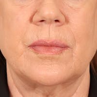Lip Lift Before & After Gallery - Patient 367395 - Image 1
