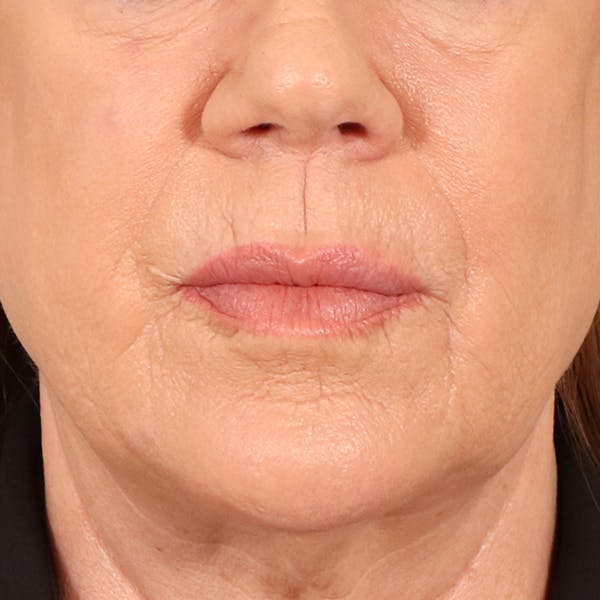 Lip Lift Before & After Gallery - Patient 367395 - Image 1