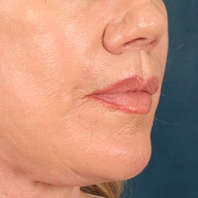 Lip Lift Before & After Gallery - Patient 367395 - Image 4