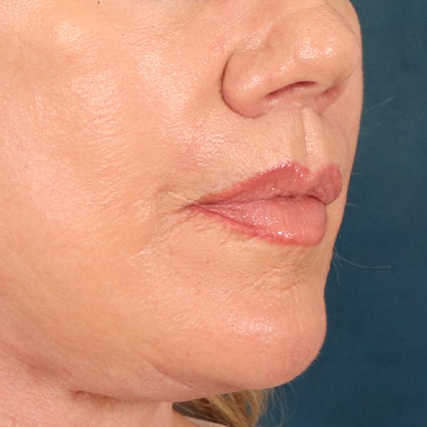 Lip Lift Before & After Gallery - Patient 367395 - Image 4