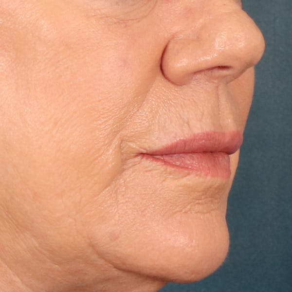 Lip Lift Before & After Gallery - Patient 367395 - Image 3