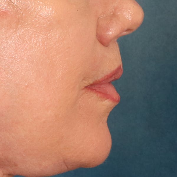 Lip Lift Before & After Gallery - Patient 367395 - Image 6