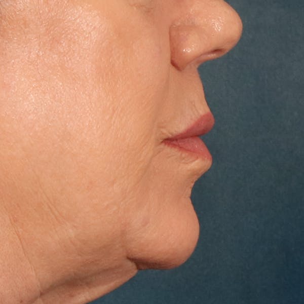 Lip Lift Before & After Gallery - Patient 367395 - Image 5