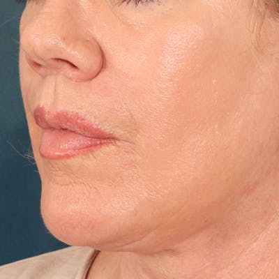 Lip Lift Before & After Gallery - Patient 367395 - Image 8