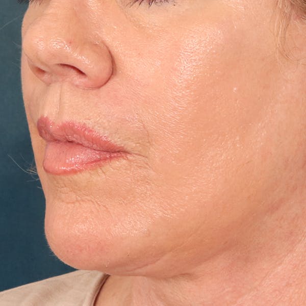 Lip Lift Before & After Gallery - Patient 367395 - Image 8