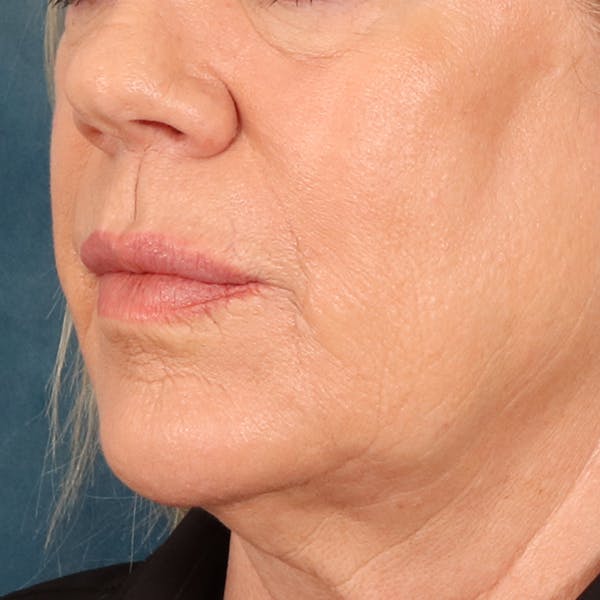 Lip Lift Before & After Gallery - Patient 367395 - Image 7