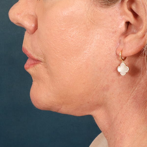 Lip Lift Before & After Gallery - Patient 367395 - Image 10