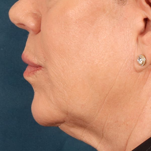 Lip Lift Before & After Gallery - Patient 367395 - Image 9