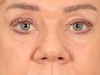 Eyelid Lift Before & After Gallery - Patient 647884 - Image 1