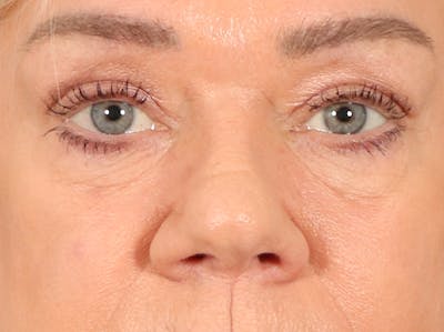 Eyelid Lift Before & After Gallery - Patient 647884 - Image 1