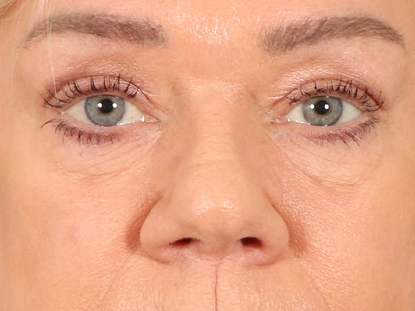 Eyelid Lift Before & After Gallery - Patient 647884 - Image 1
