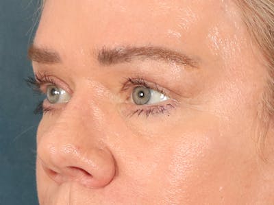 Eyelid Lift Before & After Gallery - Patient 647884 - Image 8