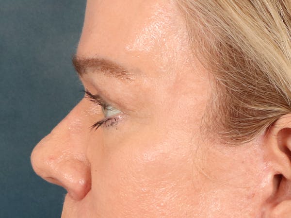 Eyelid Lift Before & After Gallery - Patient 647884 - Image 10