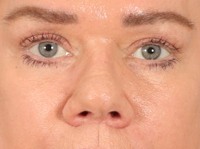 Eyelid Lift Before & After Gallery - Patient 647884 - Image 2