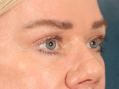 Eyelid Lift Before & After Gallery - Patient 647884 - Image 4
