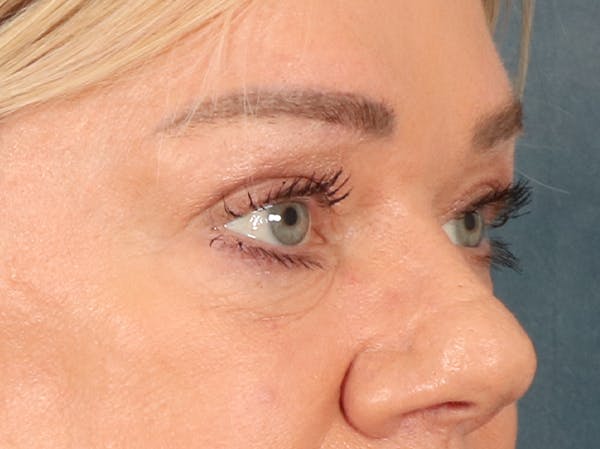 Eyelid Lift Before & After Gallery - Patient 647884 - Image 3