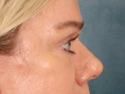 Eyelid Lift Before & After Gallery - Patient 647884 - Image 6