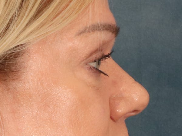Eyelid Lift Before & After Gallery - Patient 647884 - Image 5