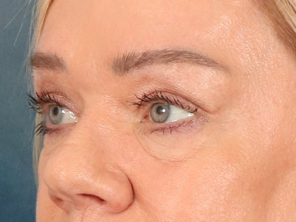 Eyelid Lift Before & After Gallery - Patient 647884 - Image 7