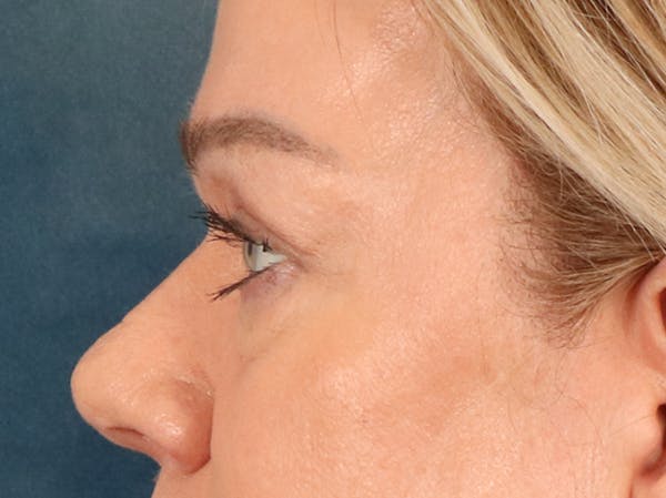 Eyelid Lift Before & After Gallery - Patient 647884 - Image 9
