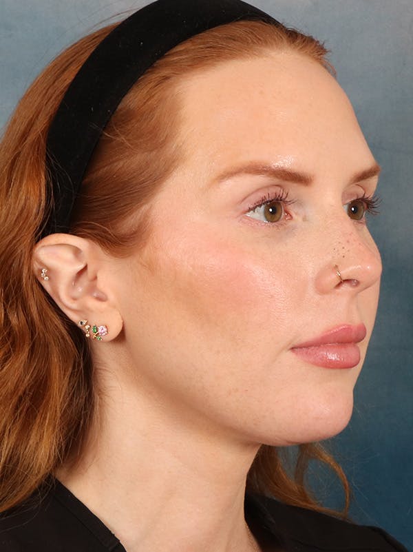 Deep Neck Lift Before & After Gallery - Patient 170386 - Image 4