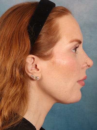 Deep Neck Lift Before & After Gallery - Patient 170386 - Image 6