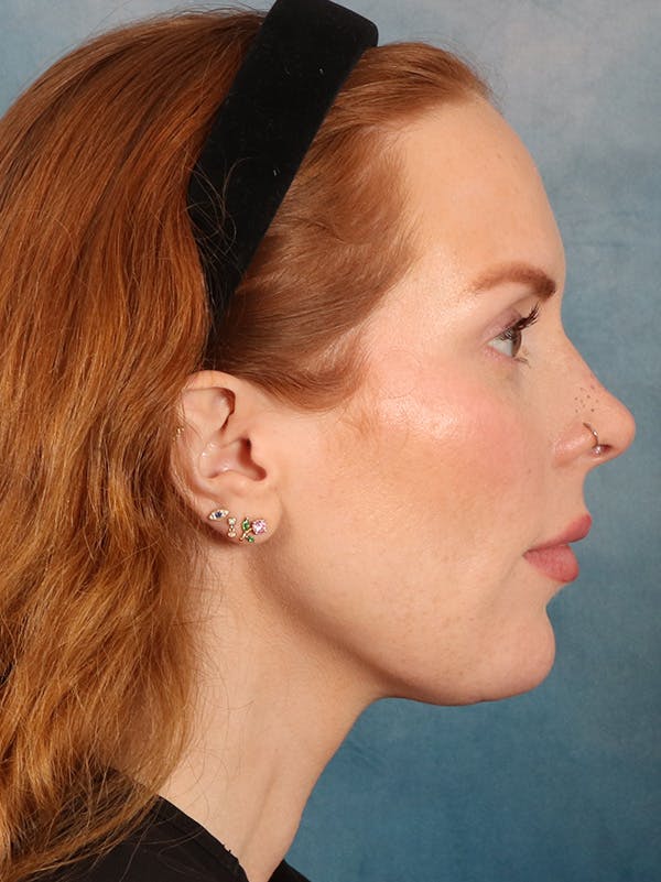 Deep Neck Lift Before & After Gallery - Patient 170386 - Image 6
