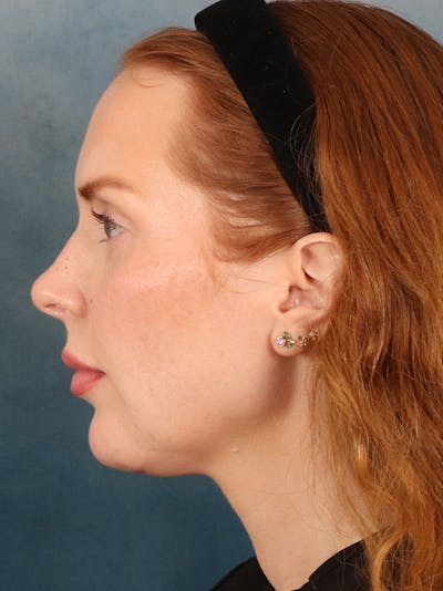 Deep Neck Lift Before & After Gallery - Patient 170386 - Image 10