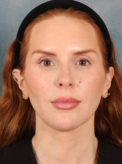 Deep Neck Lift Before & After Gallery - Patient 170386 - Image 2