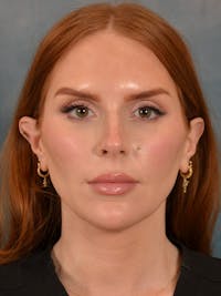 Deep Neck Lift Before & After Gallery - Patient 170386 - Image 1