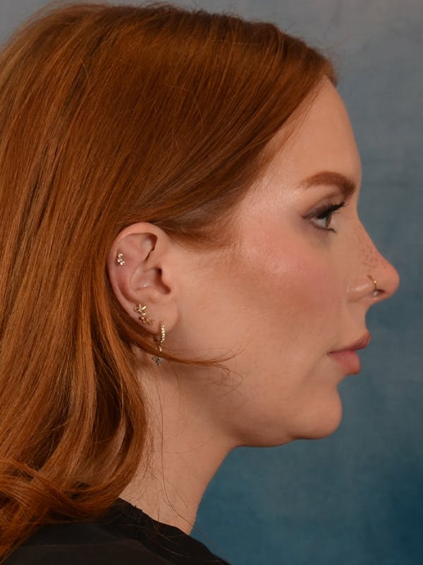 Deep Neck Lift Before & After Gallery - Patient 170386 - Image 5