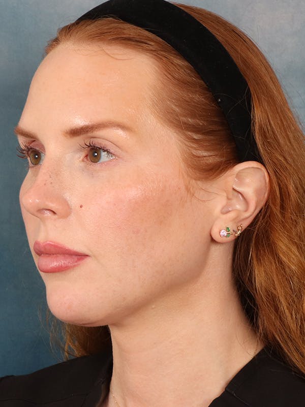 Deep Neck Lift Before & After Gallery - Patient 170386 - Image 8