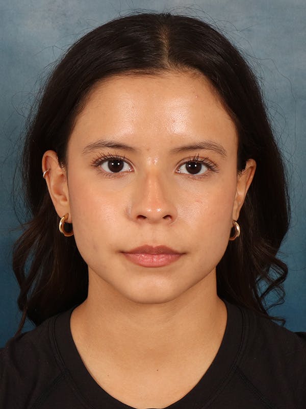 Rhinoplasty Before & After Gallery - Patient 61874293 - Image 5